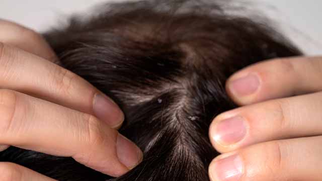Person scratching their head due to dandruff