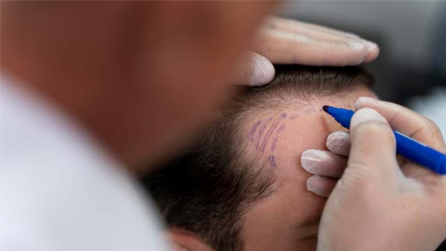What Are Grafts In Hair Transplant?