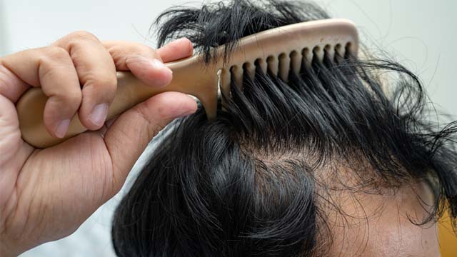 Transplanted hair not falling out