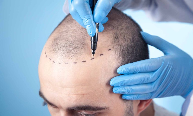 a patient suffering from hair loss consultation with doctor doctor using skin marker