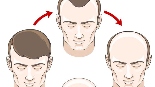 A picture showing the stages of male pattern baldness